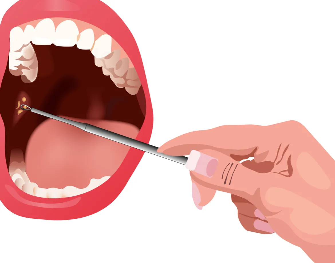 MiBrush Tonsil Stones Loop Extractor (amandelstenen)