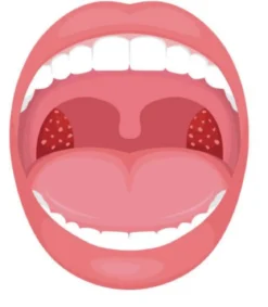 MiBrush Tonsil Stones Loop Extractor (amandelstenen)