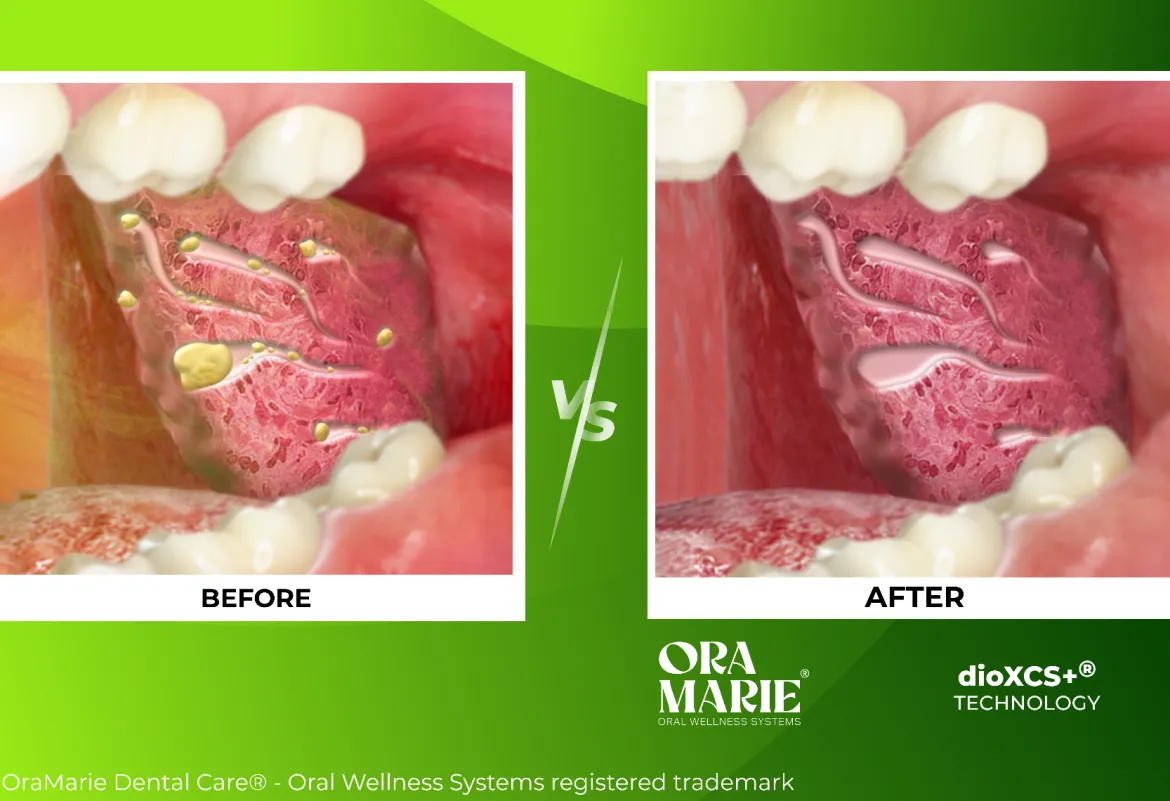 OraMarie® Tonsil Stone Removal Serum
