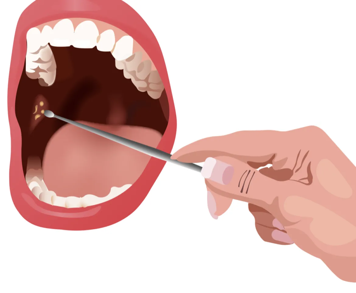 Tonsilclin Amandelstenen Verwijder Set + LED licht